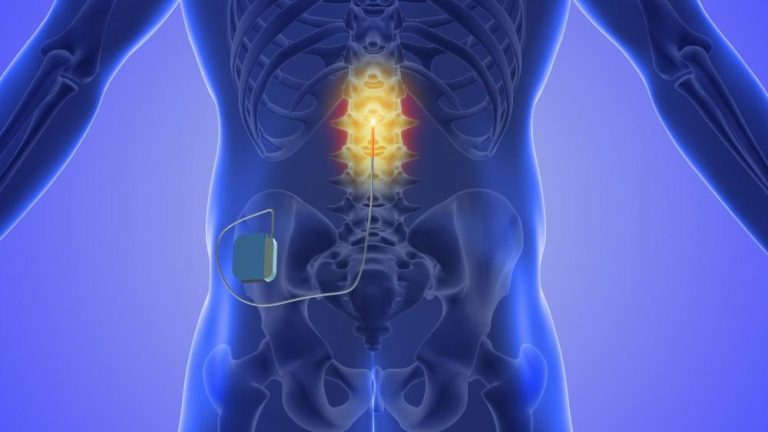 Spinal Cord Stimulator